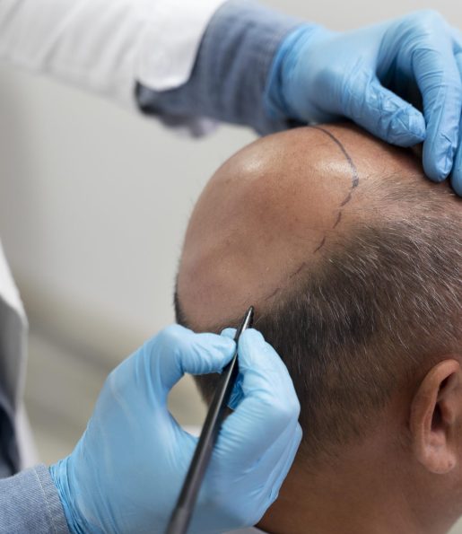 man-going-through-follicular-unit-extraction-process man-going-through-follicular-unit-extraction-process